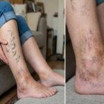 common signs of vein disease you shouldn't ignore